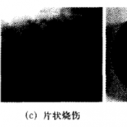 图1 钢球烧伤的表现特征